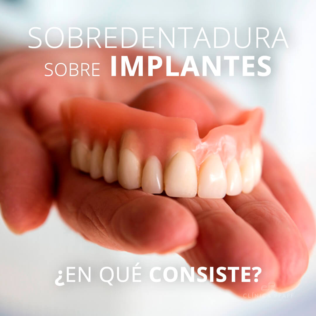 Sobredentadura sobre implantes dentales En qué consiste Clínica