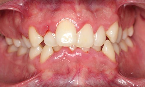 Apiñamiento-dental