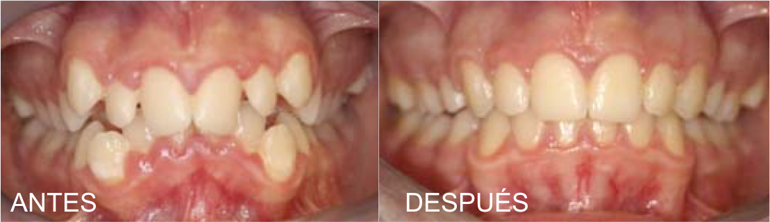 apiñamiento-dental-antes-y-despues apiñamiento-dental-antes-y-despues