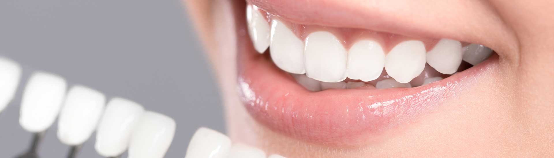 Carillas dentales - ¿Cómo se preparan y se colocan? Porcelana y resina o  composite © 