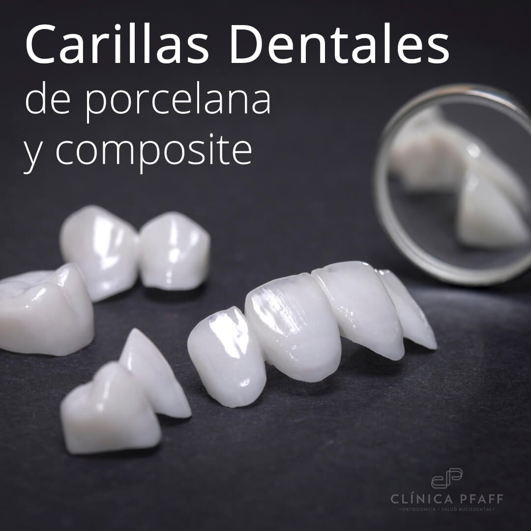 Carillas dentales de composite - Clínica Dental Zahne