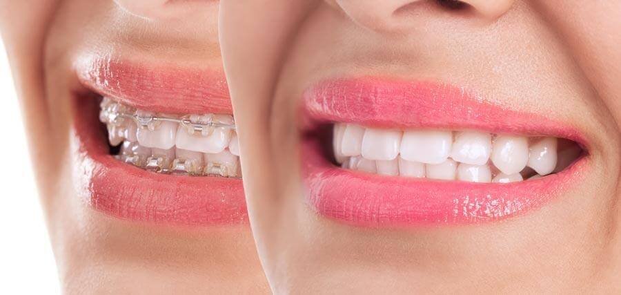 diseño-de-sonrisas-con-ortodoncia diseño-de-sonrisas-con-ortodoncia