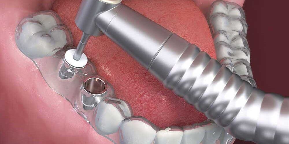 implantes-dentales-con-cirugia-guiada