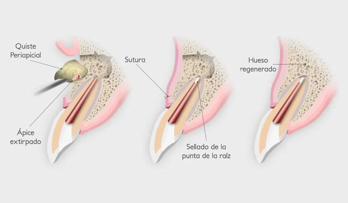 apicectomia-que-es