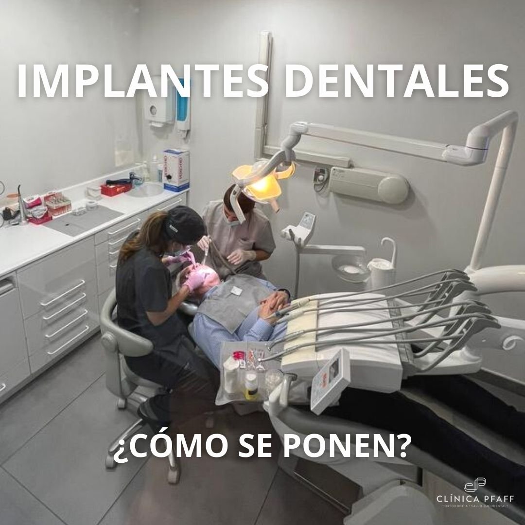 implantes-dentales-como-se-ponen implantes-dentales-como-se-ponen