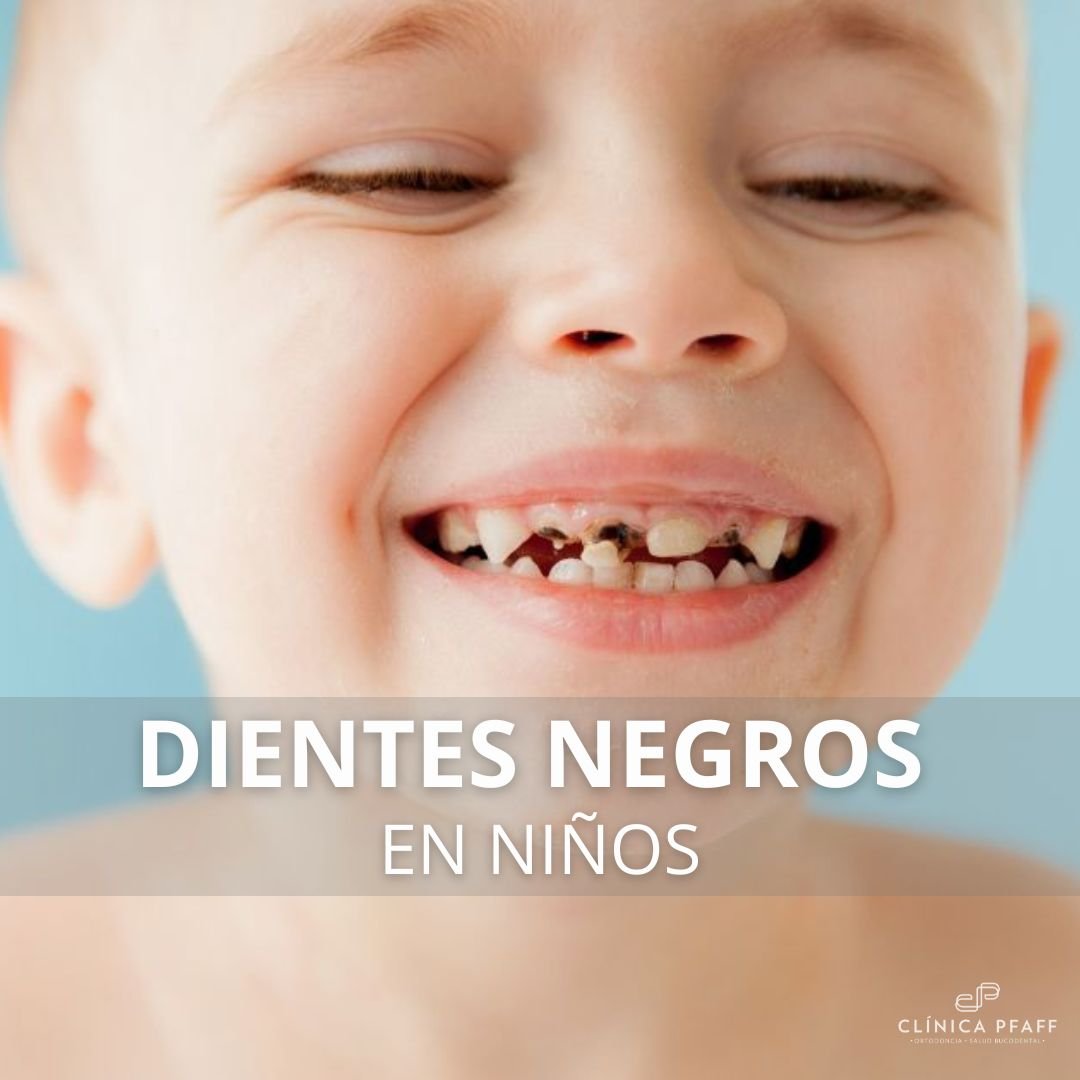 dientes-negros-en-niños-barcelona-pfaff dientes-negros-en-niños-barcelona-pfaff