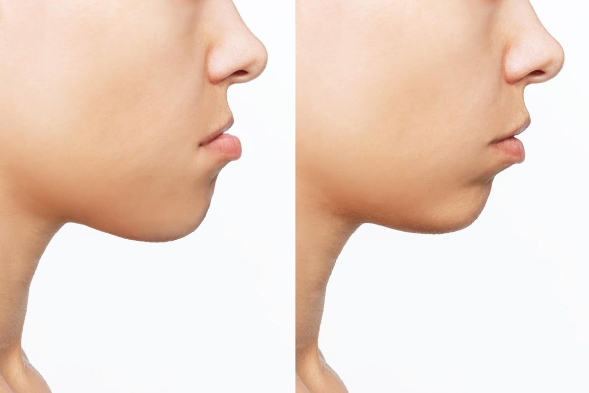 mordida-invertida-antes-despues-tratamiento-ortodoncia-barcelona-clinica-pfaff mordida-invertida-antes-despues-tratamiento-ortodoncia-barcelona-clinica-pfaff