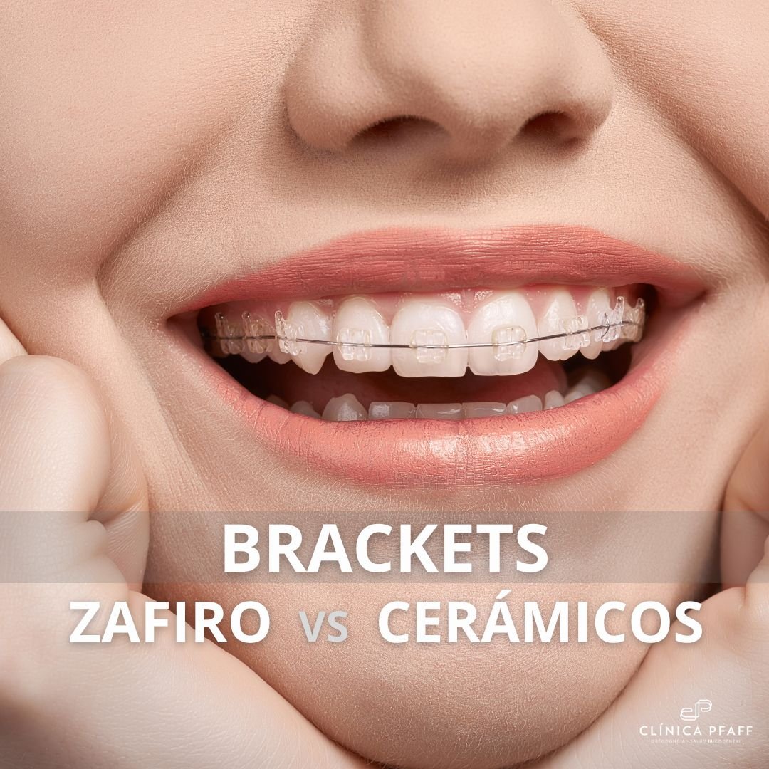 ortodoncia-brackets-zafiro-vs-ceramicos ortodoncia-brackets-zafiro-vs-ceramicos