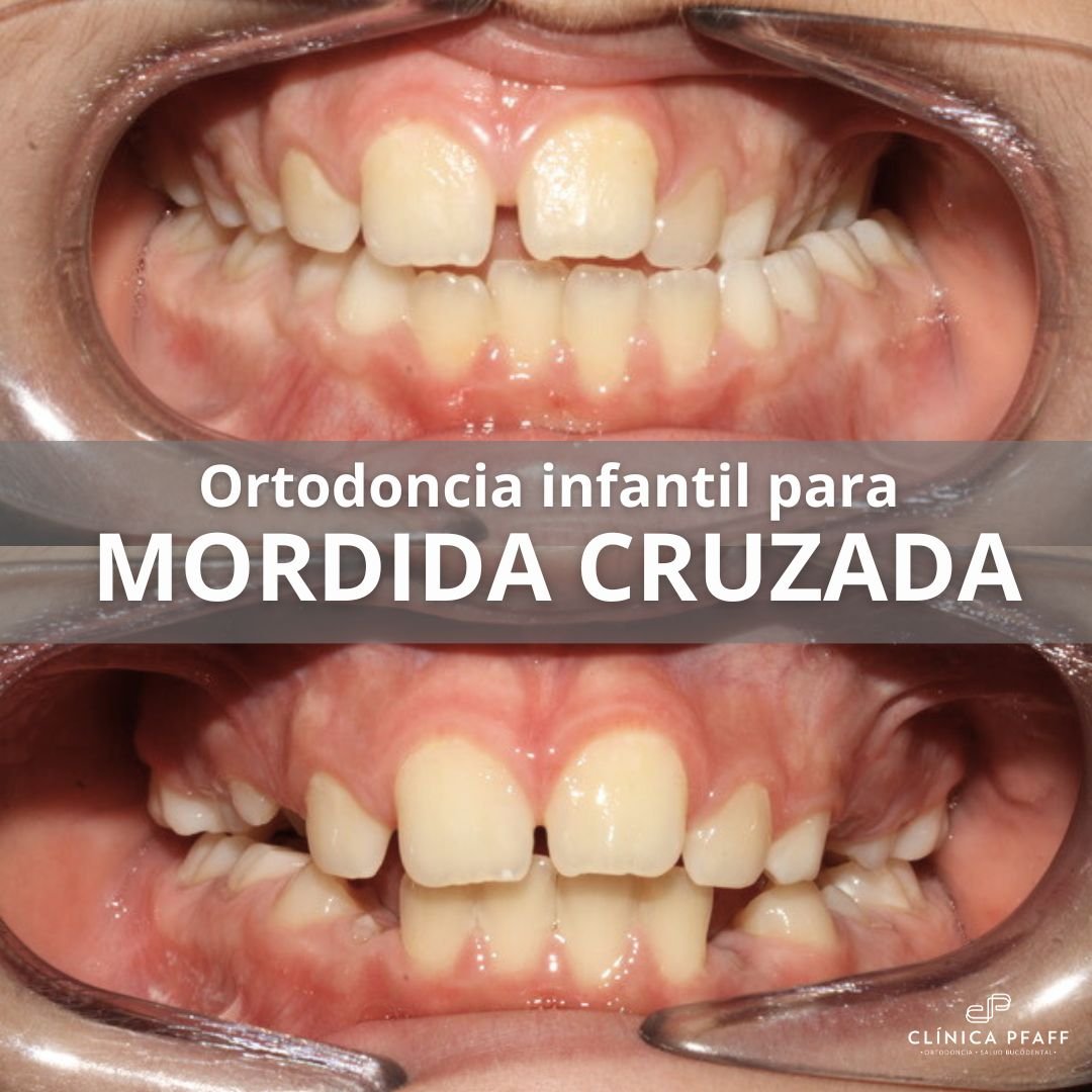 ortodoncia-infantil-mordida-cruzada-barcelona