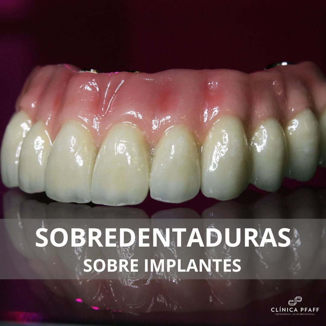 sobredentaduras-sobre-implantes-barcelona-clinica-pfaff