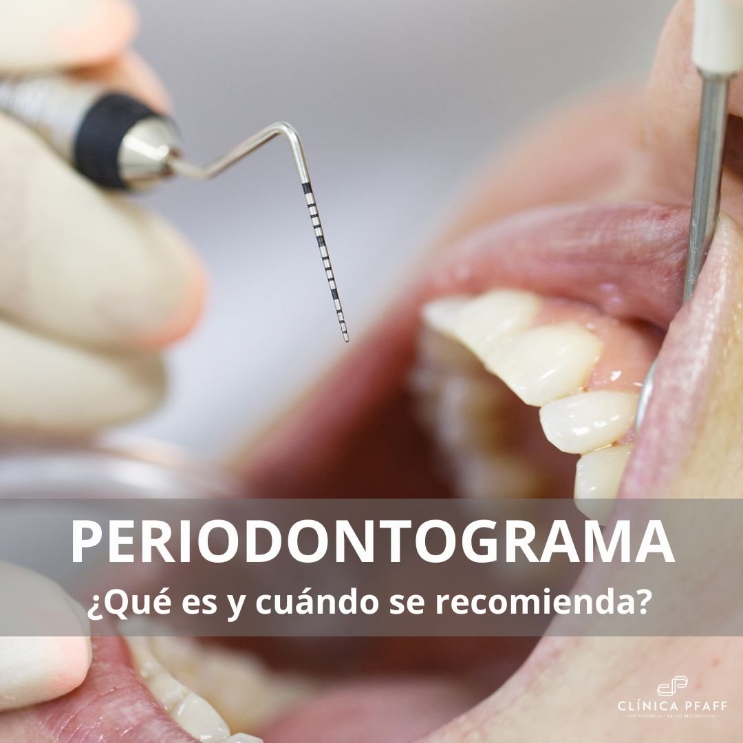 periodontograma-que-es-Clinica-Pfaff-Barcelona periodontograma-que-es-Clinica-Pfaff-Barcelona