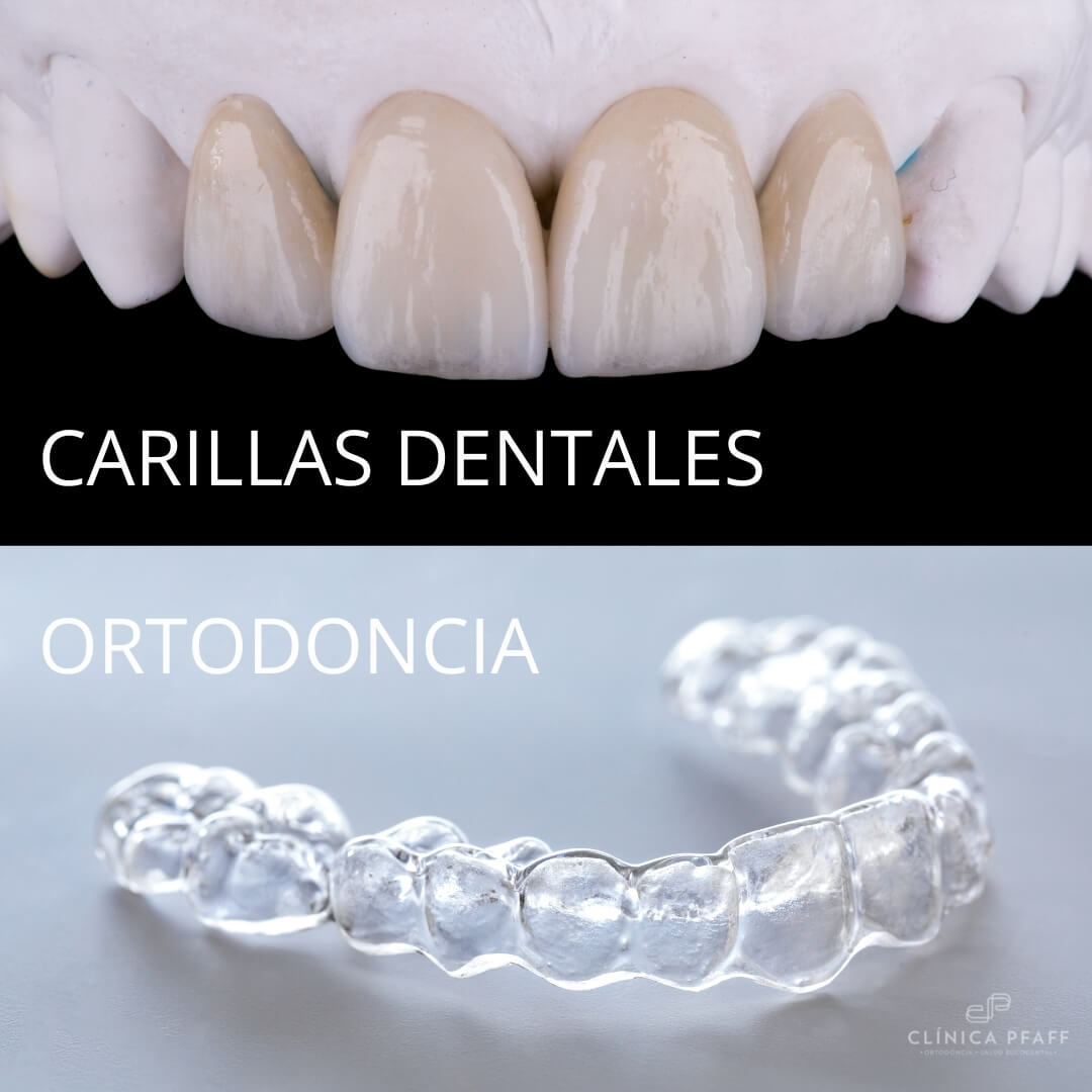 ¿Tratamiento de ortodoncia o carillas?